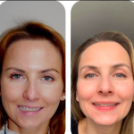 BEFORE & AFTER