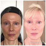 BEFORE & AFTER
